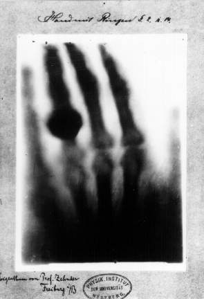 First medical X-ray, Wilhelm Rontgen's wife's hand with a fairly sizable ring!